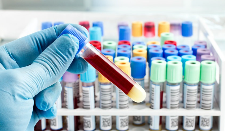 Liberado exame de sangue para detectar alzheimer