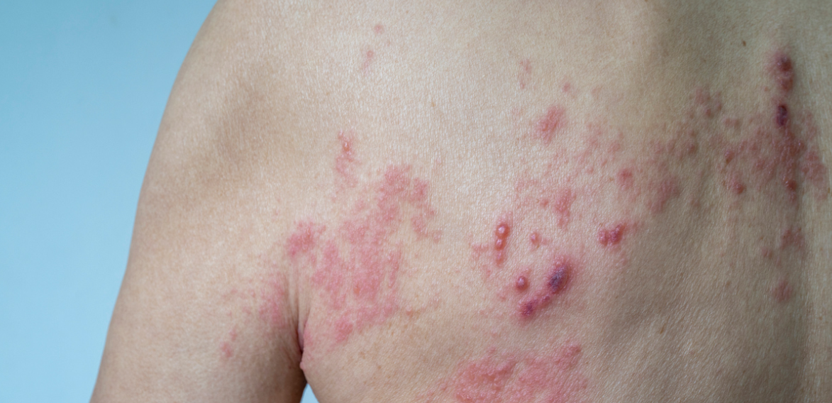 Atualmente, o imunizante está disponível apenas na rede privada, com custo que pode ultrapassar R$ 2 mil pelas duas doses necessárias