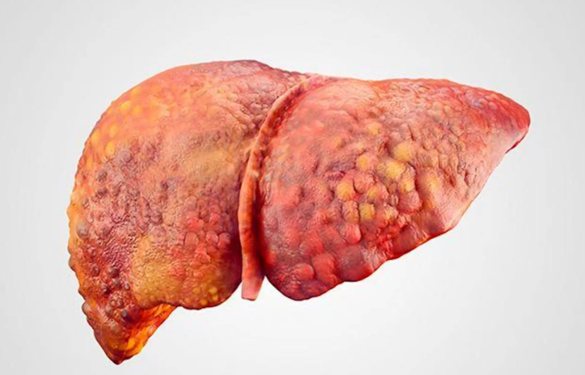 Cientistas da Universidade da Califórnia, em San Diego, anunciaram um avanço promissor no combate à esteato-hepático associada à disfunção metabólica (MASH), forma grave da doença hepática gordurosa relacionada à obesidade e ao diabete tipo 2.