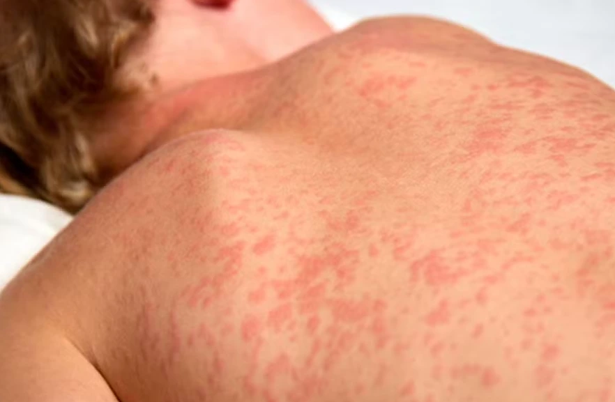 O sarampo voltou a crescer em ritmo que preocupa autoridades de saúde nos Estados Unidos e já coloca o país no caminho de perder o “status de eliminação” da doença — um marco sanitário mantido desde 2000.