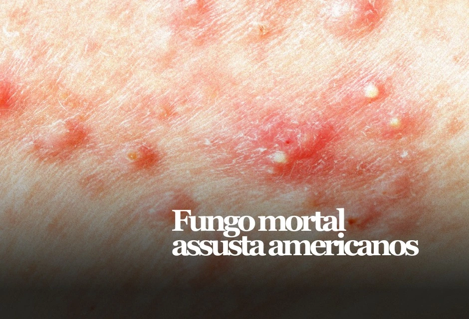 CDC contabiliza 7.046 casos clínicos de Candida em 2025, com registros em 27 estados. O risco maior é em hospitais e instituições de longa permanência.