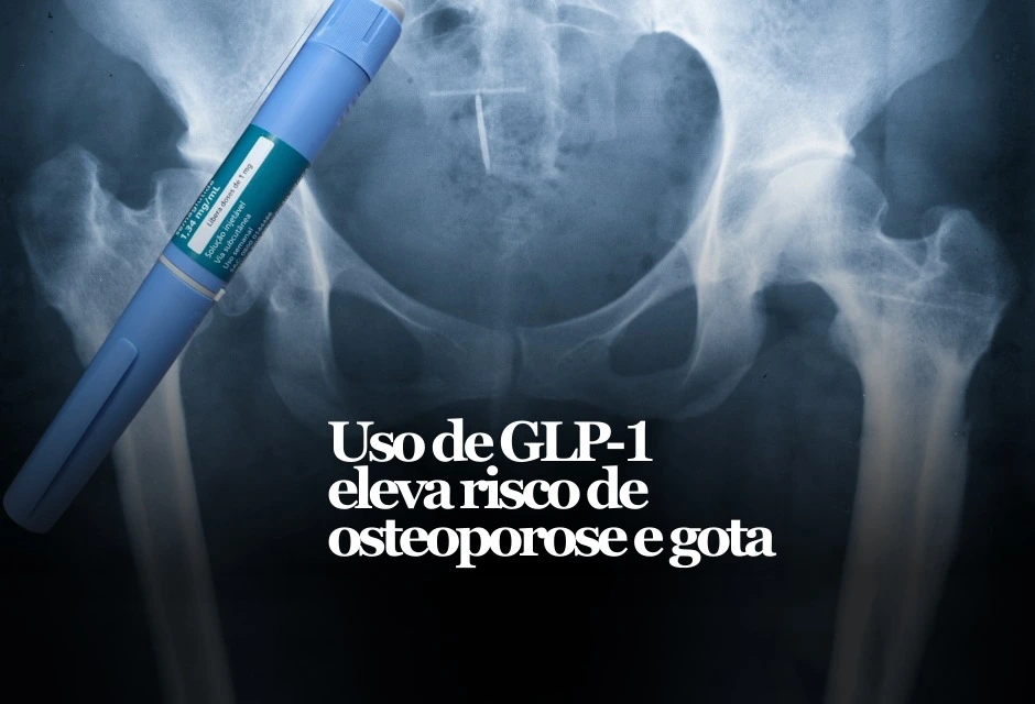 Um novo estudo apresentado na reunião anual da Academia Americana de Cirurgiões Ortopédicos sugeriu que usuários de remédios GLP-1 (como semaglutida e liraglutida) podem ter risco um pouco maior de osteoporose e gota em comparação com pacientes semelhantes que não usaram a classe.