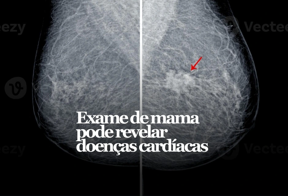 Um exame feito de rotina para rastrear câncer de mama também pode trazer um outro alerta: o risco de doença cardiovascular. Estudo publicado nesta segunda-feira (9) no European Heart Journal indica que a presença de calcificação arterial mamária — depósito de cálcio nas artérias da mama — vista na mamografia pode ajudar a prever infarto, AVC e m0rt3 por causa cardíaca.