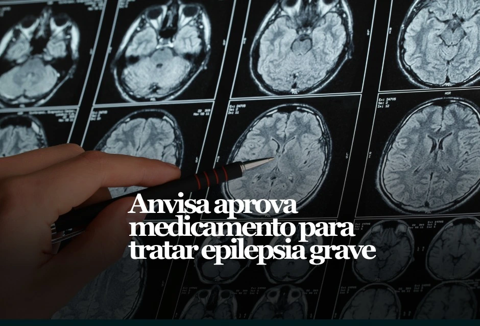 A Anvisa aprovou o registro do cenobamato, comercializado como Xcopri, para o tratamento adjuvante de crises epilépticas focais em adultos com epilepsia que seguem sem controle adequado mesmo após o uso de pelo menos dois medicamentos anticrise.