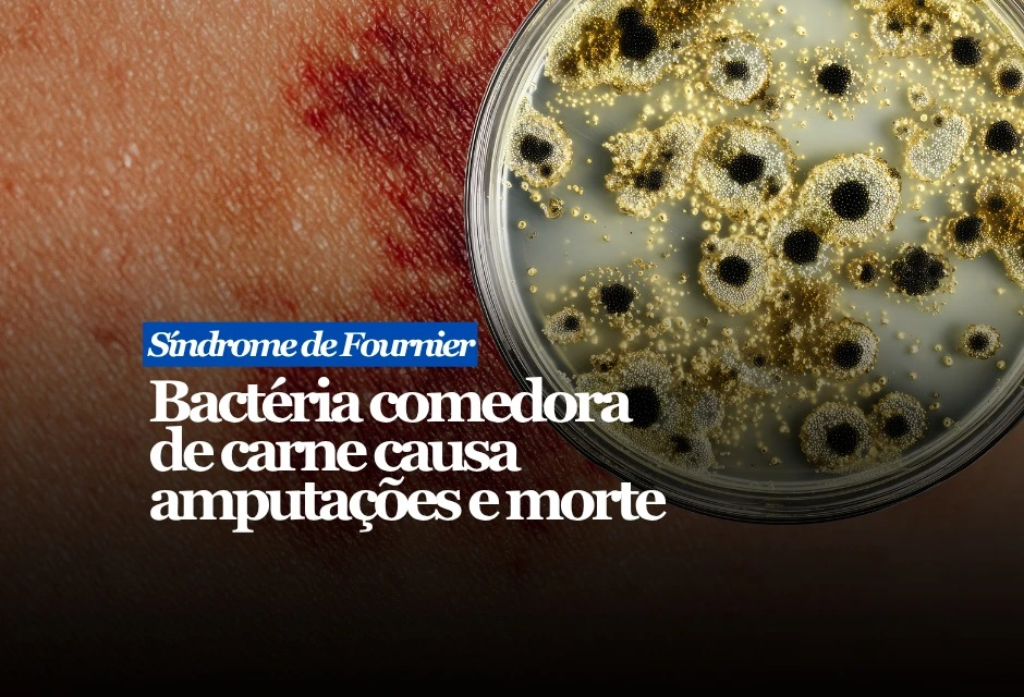 A gangrena de Fournier é uma emergência médica. A infecção, conhecida popularmente como “bactéria comedora de carne”, atinge a região genital, perineal ou ao redor do ânus e pode evoluir em poucas horas ou dias. O apelido chama atenção, mas não explica tudo: na maioria dos casos, o quadro envolve mais de um tipo de bactéria e exige resposta rápida.