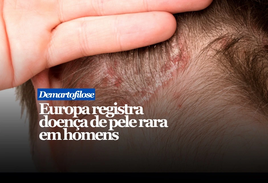 A doença é causada pela bactéria Dermatophilus congolensis, mais comum em bovinos, ovinos e cavalos. Nos casos descritos por pesquisadores em Lyon, Paris e Barcelona, os pacientes não relataram contato com animais infectados, o que levantou a suspeita de transmissão entre pessoas por contato próximo.
