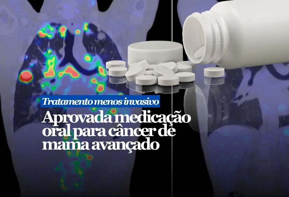 A Anvisa aprovou o registro de um novo medicamento oral para casos específicos de câncer de mama avançado. O remédio se chama Inluriyo, nome comercial do tosilato de inlunestranto, e foi desenvolvido pela Eli Lilly do Brasil. A indicação é para adultos com tumor localmente avançado, que não pode ser retirado por cirurgia, ou metastático, quando a doença já se espalhou para outras partes do corpo.