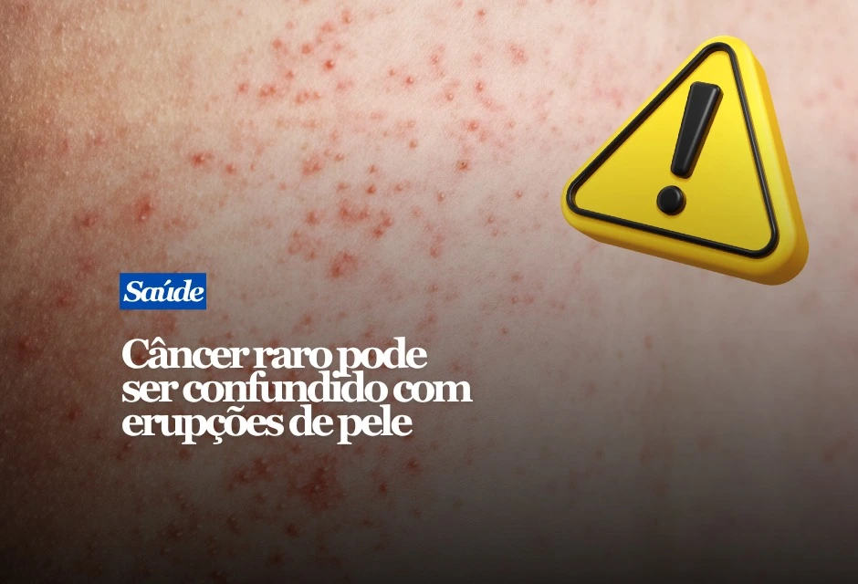 Coceira persistente, ardor e uma mancha avermelhada ou descamativa na região genital podem parecer dermatite ou micose. Em casos raros, porém, esses sinais estão ligados à doença de Paget extramamária, um tipo incomum de câncer de pele. A doença costuma aparecer na vulva, mas também pode atingir pênis, escroto e região ao redor do ânus. É mais frequente em mulheres entre 50 e 80 anos e pode crescer lentamente, o que contribui para atrasos no diagnóstico.