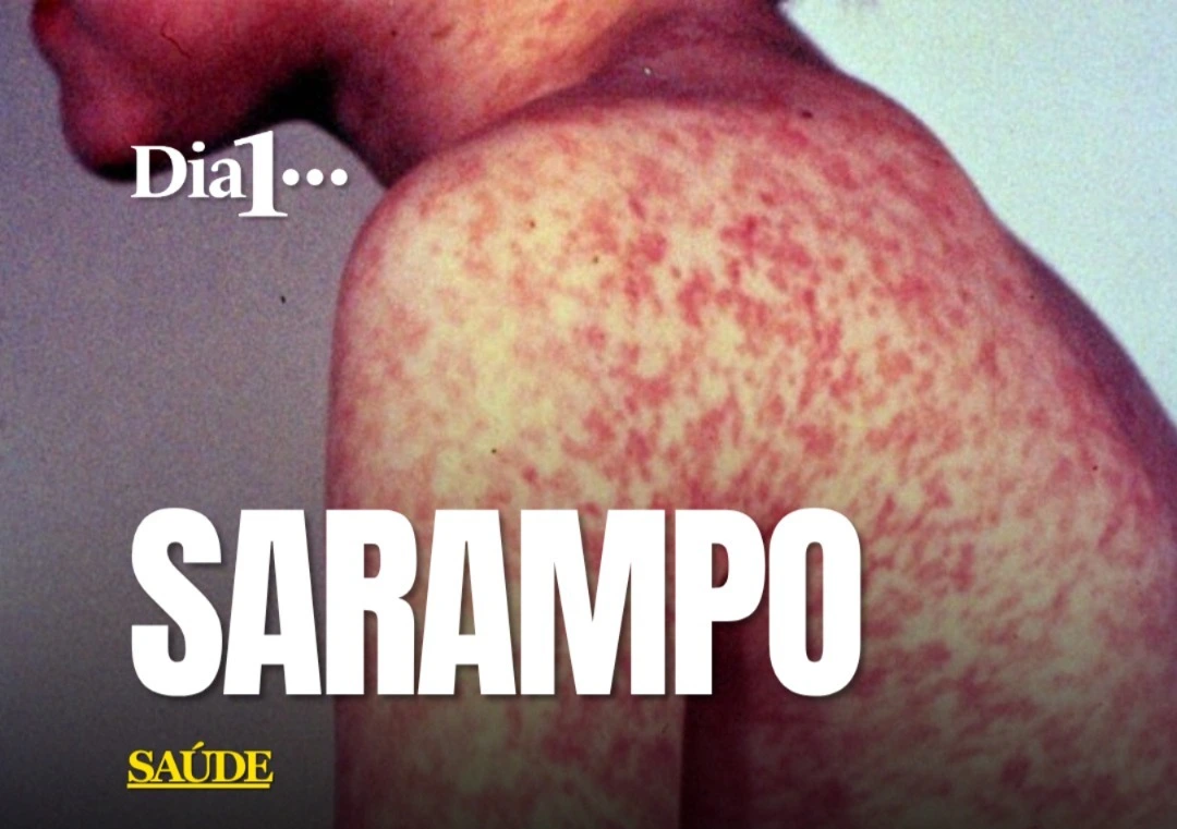 O Brasil voltou a acender o alerta para o sarampo. Dados do Ministério da Saúde mostram que apenas 35,2% dos municípios atingiram, em 2025, a meta de 95% de cobertura da segunda dose da tríplice viral. Isso significa que quase 65% das cidades ficaram abaixo do nível recomendado. Na primeira dose, o cenário é melhor: 64,6% dos municípios alcançaram a meta. A diferença é importante porque não significa que 65% das cidades estejam com baixa cobertura em todas as etapas da vacinação, mas revela uma fragilidade justamente na conclusão do esquema.